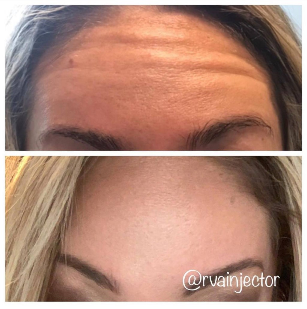 Botox & Dermal Fillers – Here’s Everything You Need to&nbsp;Know